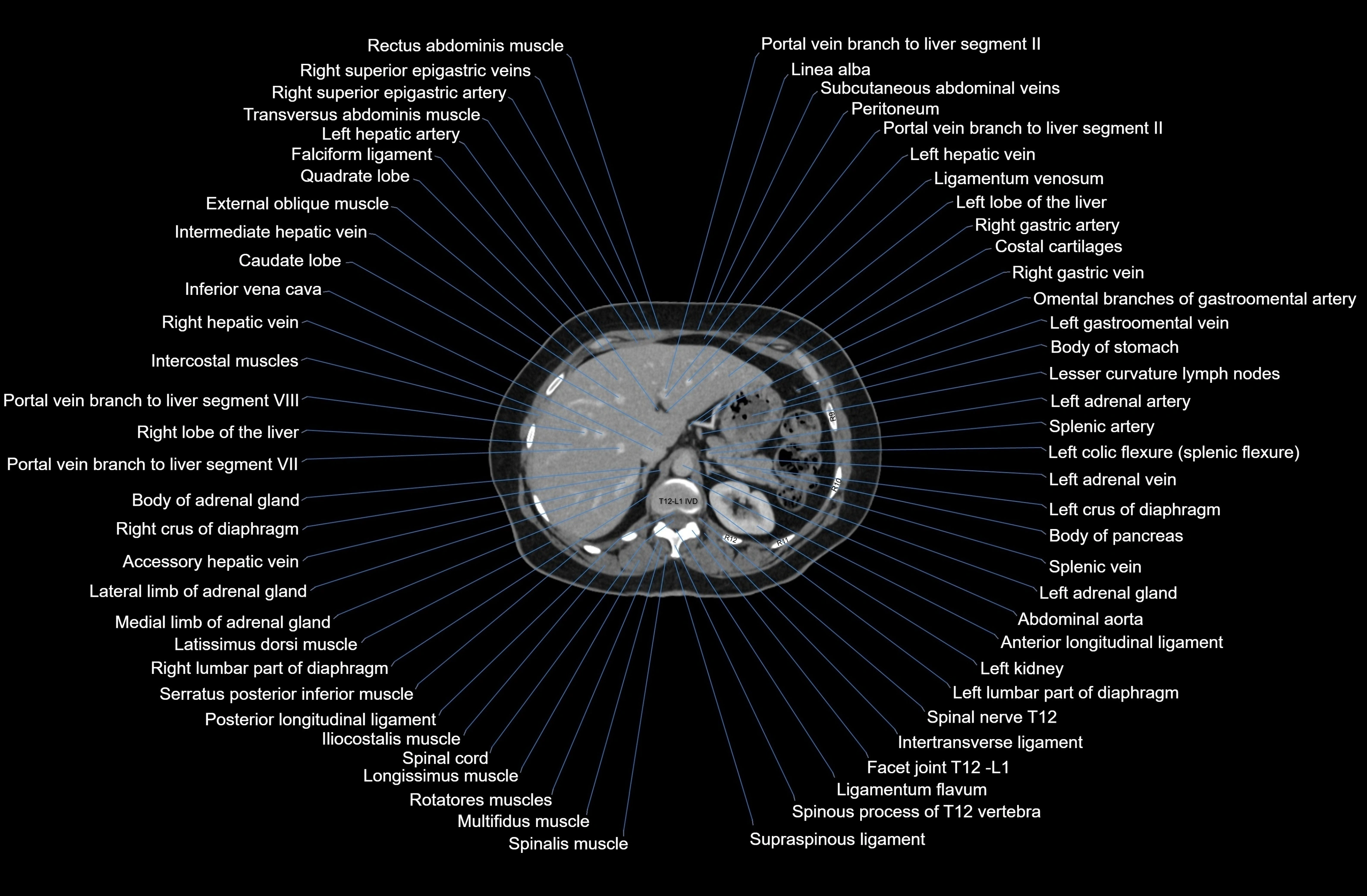 CT Abdomen axial cross sectional anatomy labelled radiology image-00022.webp
